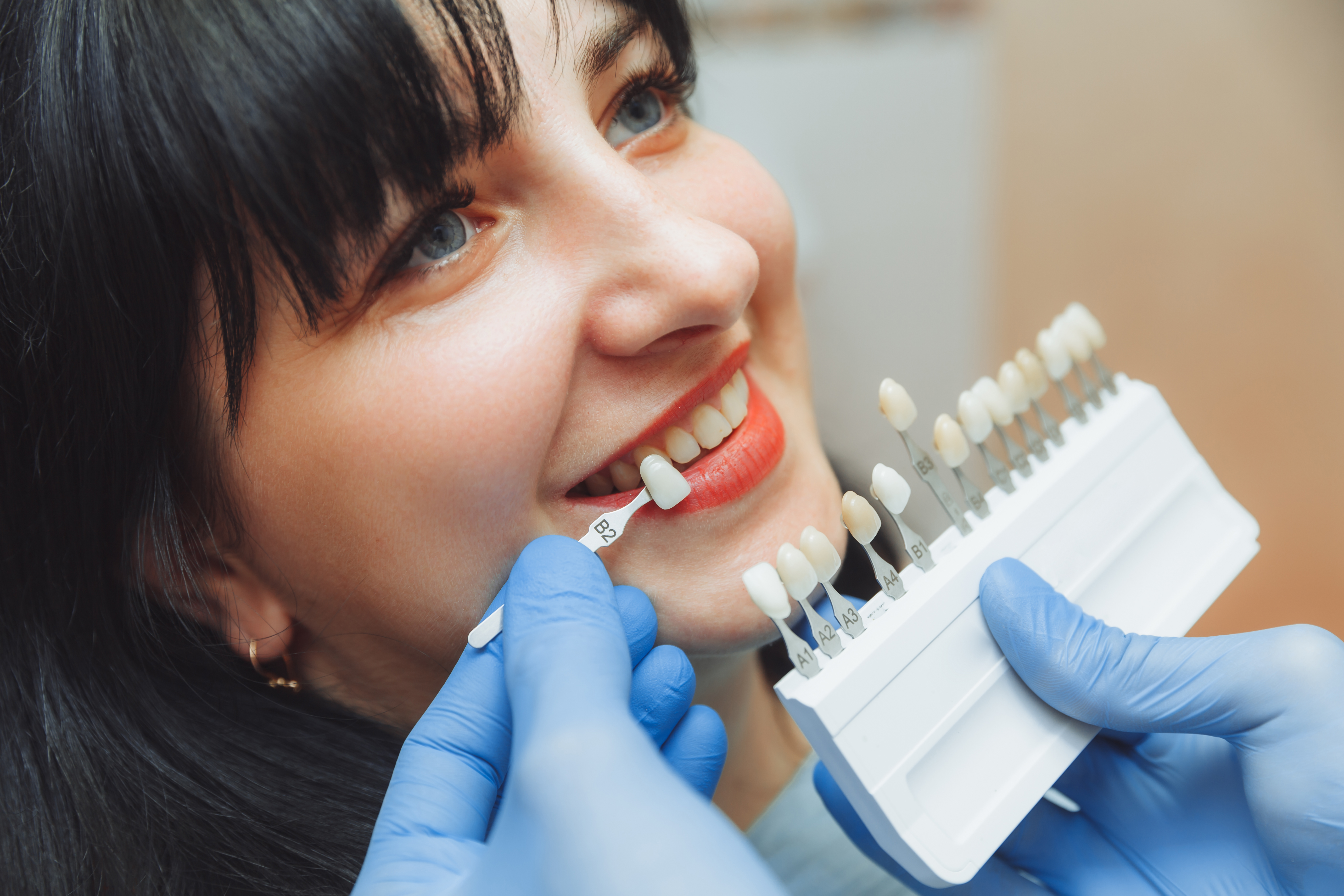 Porcelain veneers in Edmonton